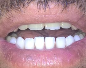 دندانسازی محلاتی اصفهان09162894028